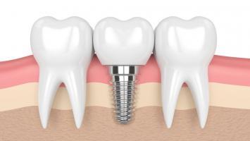 Địa chỉ trồng  răng implant uy tín nhất quận Hai Bà Trưng, Hà Nội
