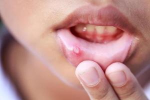 Siro trị nhiệt miệng cho bé tốt nhất hiện nay