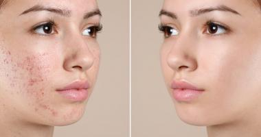 Bộ sản phẩm trị mụn, dưỡng da tốt nhất hiện nay