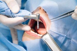 Địa chỉ trồng răng implant tốt nhất tỉnh Thừa Thiên Huế