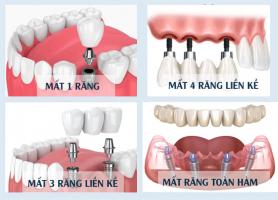 Nha khoa trồng răng implant uy tín nhất tại Quận 1, TP. HCM