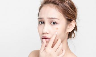 Cách trị mụn mùa hè hiệu quả nhất bạn nên áp dụng