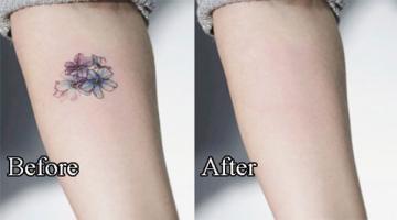 Địa chỉ xóa xăm uy tín nhất tại Sài Gòn