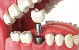 Địa chỉ trồng  răng implant uy tín nhất quận Thanh Xuân, Hà Nội