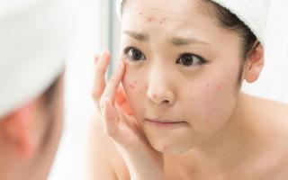 Địa chỉ spa trị mụn hiệu quả, uy tín nhất tại Hà Nội