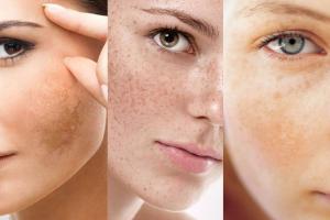 Spa trị nám hiệu quả nhất quận Hoàn Kiếm, Hà Nội