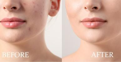 Spa trị mụn hiệu quả nhất quận Long Biên, Hà Nội