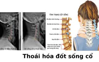 Bác sĩ khám chữa thoái hoá đốt sống cổ giỏi nhất tại Hà Nội