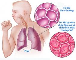 Bệnh thường gặp nhất vào mùa đông và cách phòng tránh