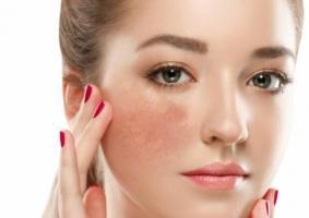 Bộ sản phẩm trị nám tốt nhất hiện nay