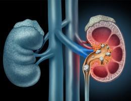 Cách trị sỏi thận tại nhà không cần dùng thuốc