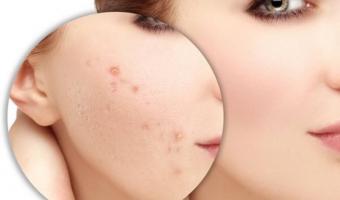 Cách trị thâm do mụn để lại hiệu quả nhất