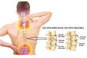 Chuyên gia khám chữa thoái hóa cột sống đầu ngành tốt nhất tại TP.HCM