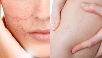 Địa chỉ điều trị giãn mao mạch hiệu quả nhất Hà Nội