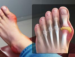 Bệnh viện khám và điều trị bệnh gout uy tín hiệu quả tại Hà Nội