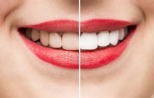 Địa chỉ lấy cao răng an toàn và uy tín nhất Hải Phòng