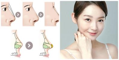 Địa chỉ nâng mũi sụn tự thân uy tín nhất tại TP.HCM