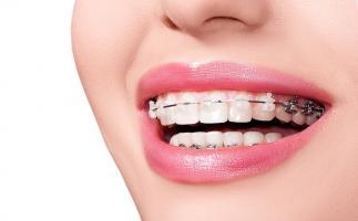 Địa chỉ niềng răng uy tín nhất tại TP. Buôn Ma Thuột