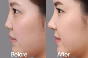 Địa chỉ tiêm filler mũi uy tín nhất tại TP. HCM