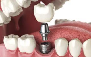 Địa chỉ trồng răng implant tốt nhất tỉnh Bình Định