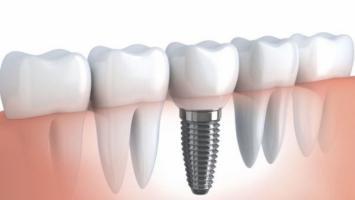 Địa chỉ trồng răng implant tốt nhất tỉnh Khánh Hòa