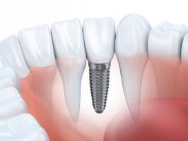 Địa chỉ trồng răng implant tốt nhất tỉnh Lạng Sơn