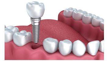 Địa chỉ trồng răng implant tốt nhất tỉnh Phú Yên