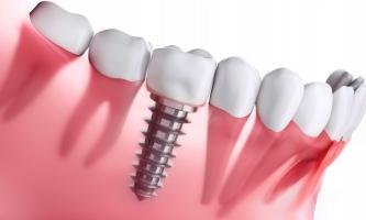 Địa chỉ trồng răng implant tốt nhất tỉnh  Quảng Nam