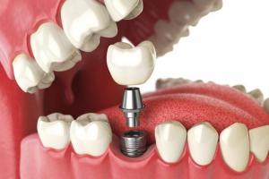 Địa chỉ trồng răng implant tốt nhất Cà Mau
