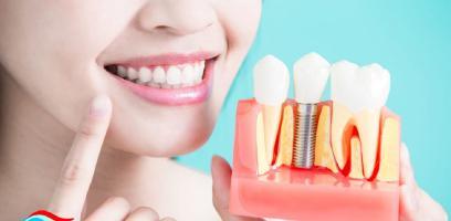 Địa chỉ trồng  răng implant uy tín nhất Quận 10, TP HCM