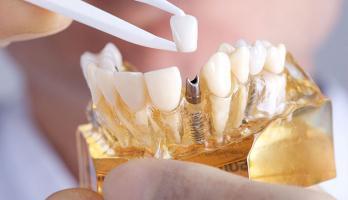 Địa chỉ trồng răng implant uy tín nhất quận Hoàn Kiếm, Hà Nội