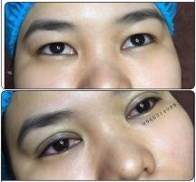 Địa chỉ nhấn mí, cắt mí đẹp và an toàn nhất Tuyên Quang