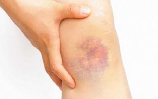 Kem tan vết bầm tím hiệu quả nhất hiện nay
