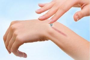 Kem trị sẹo của Mỹ tốt nhất hiện nay