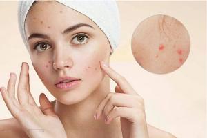 Loại kem trị mụn dược mỹ phẩm an toàn và hiệu quả nhất hiện nay