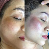 Spa trị nám tốt nhất Phú Quốc