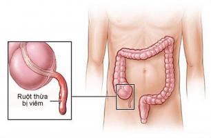 Lưu ý quan trọng nhất về viêm ruột thừa