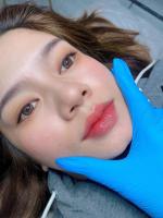 Địa chỉ tiêm filler, nhấn mí đẹp và an toàn nhất tại Phú Quốc, Kiên Giang