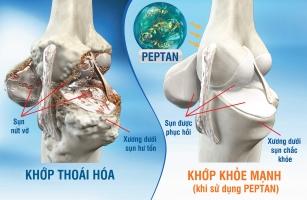 Nguyên nhân dẫn đến bệnh về khớp bạn nên chú ý