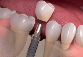 Địa chỉ trồng  răng implant uy tín nhất quận Long Biên, Hà Nội