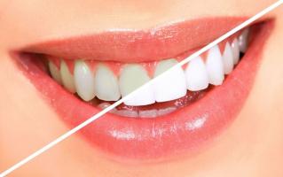 Địa chỉ tẩy trắng răng uy tín nhất tỉnh Bắc Giang