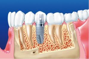 Địa chỉ trồng răng implant tốt nhất tỉnh Bình Thuận