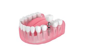 Nha khoa trồng răng implant uy tín nhất tại TP. Thủ Đức, TP HCM