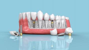 Địa chỉ trồng răng implant tốt nhất Trà Vinh
