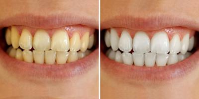 Địa chỉ tẩy trắng răng uy tín nhất tỉnh Kon Tum