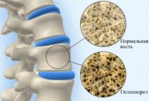 Thực phẩm giúp ngăn ngừa loãng xương hiệu quả