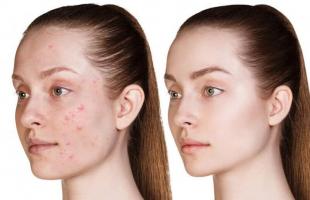 Spa trị mụn hiệu quả nhất Bến Tre