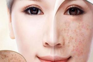 Spa trị nám tốt nhất tỉnh Thừa Thiên Huế