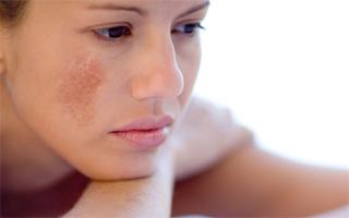 Spa trị nám tốt nhất Vĩnh Long