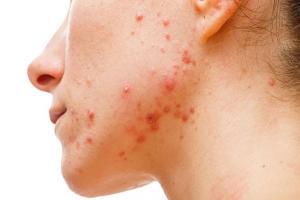 Thẩm mỹ viện trị mụn tại  TP. HCM uy tín, có bác sĩ giỏi